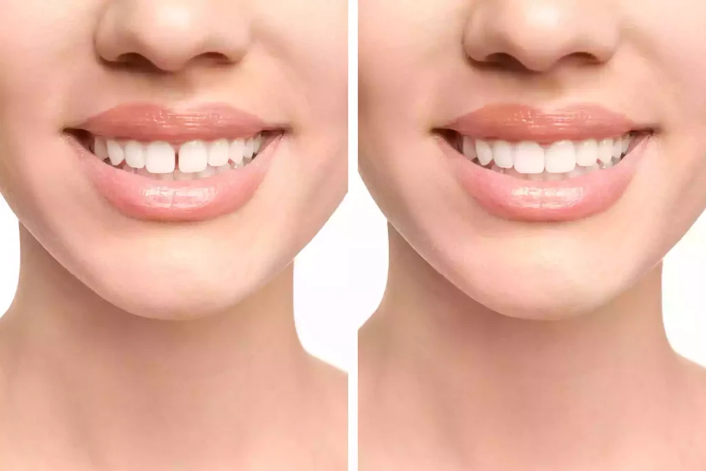 صور قبل وبعد تجميل الأسنان