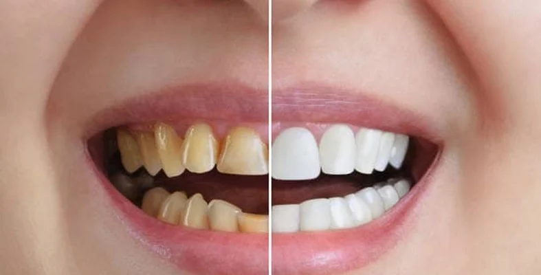 صور قبل وبعد تجميل الأسنان